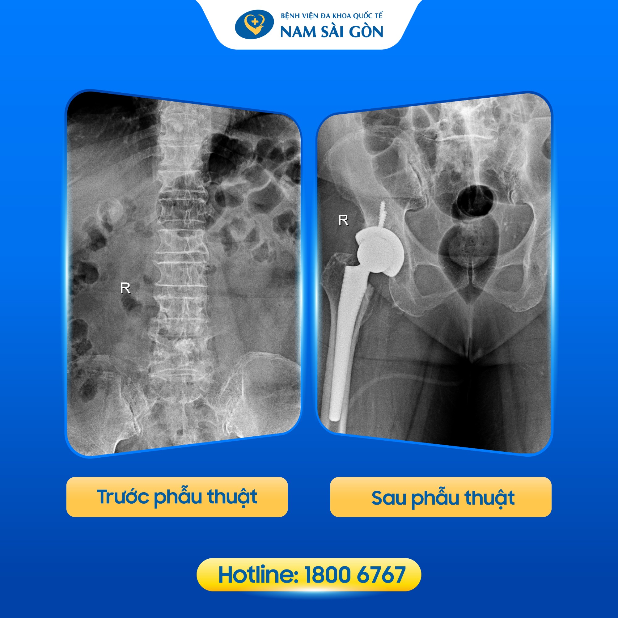 thay_khop_hang_nhan_tao_02_1 thay khop hang nhan tao 02 1