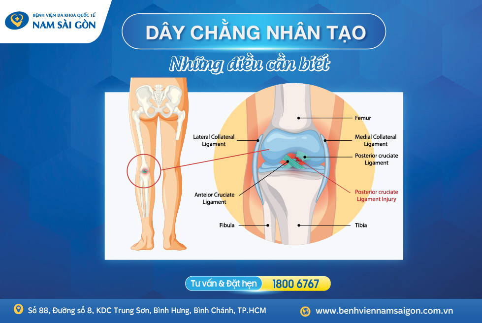 DÂY CHẰNG NHÂN TẠO – NHỮNG THÔNG TIN CẦN BIẾT