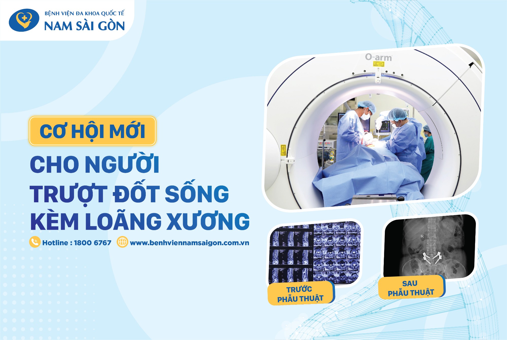 ỨNG DỤNG O-ARM TRONG PHẪU THUẬT BẮT VÍT QUA DA NẮN CHỈNH TRƯỢT ĐỐT SỐNG CHO NGƯỜI BỆNH CAO TUỔI NHIỀU BỆNH NỀN