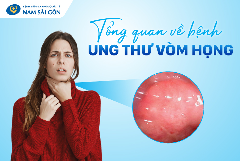 UNG THƯ VÒM HỌNG – NGUYÊN NHÂN, TRIỆU CHỨNG, ĐIỀU TRỊ VÀ PHÒNG NGỪA