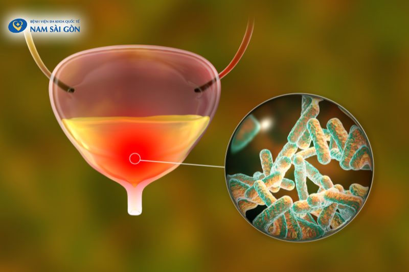 Vi khuẩn Escherichia Coli chiếm 80% nguyên nhân gây bệnh