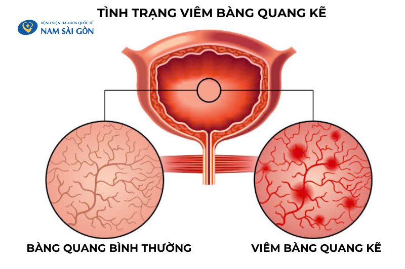 Khiếm khuyết ở lớp niêm mạc bàng quang có thể gây viêm bàng quang kẽ