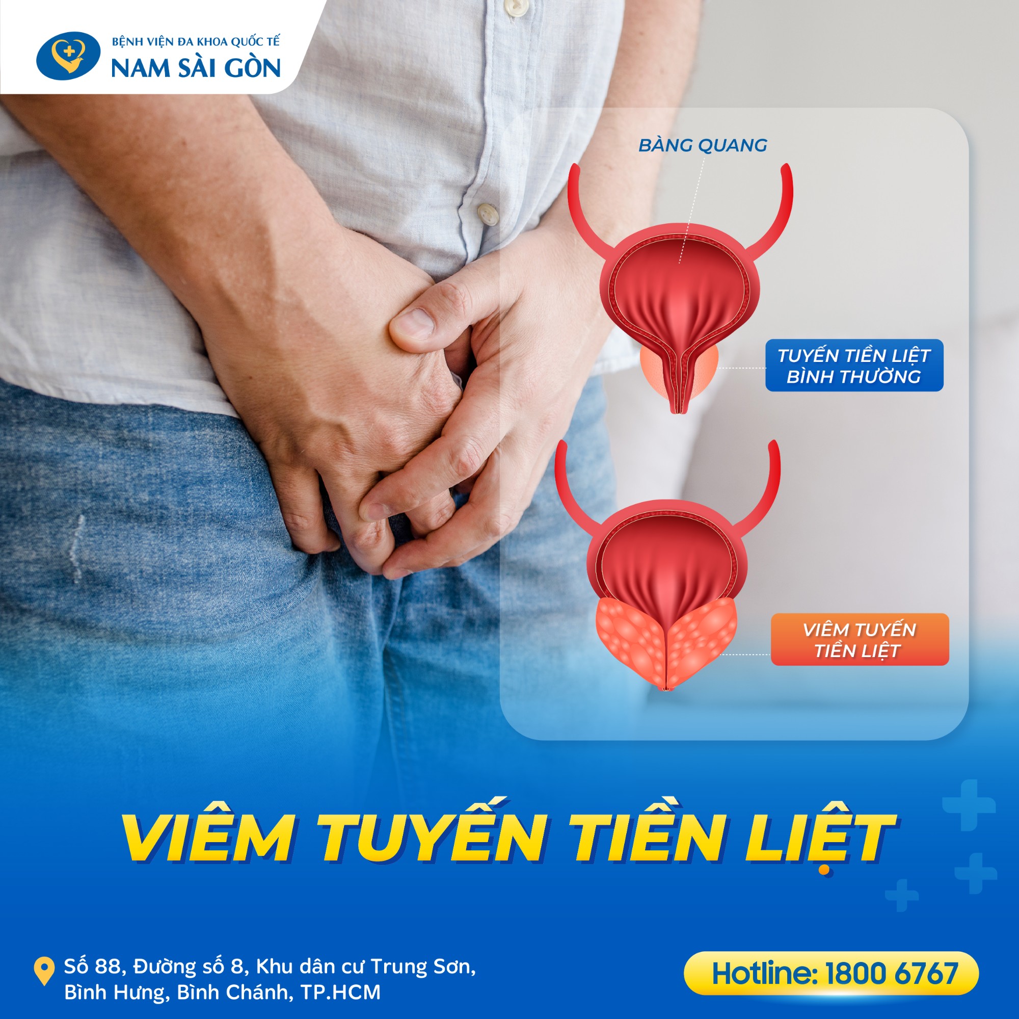 Nguyên nhân gây viêm tuyến tiền liệt cấp tính Nguyên nhân gây viêm tuyến tiền liệt cấp tính