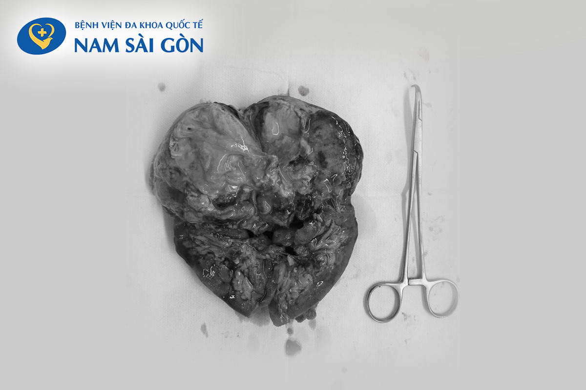 web_1-1 Hình ảnh khối bướu sau khi phẫu thuật