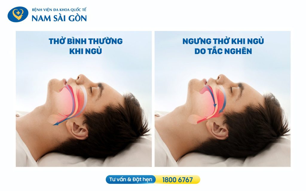 cách trị ngáy ngủ