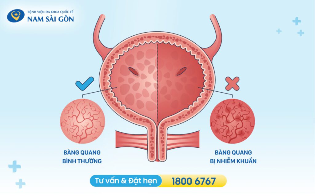 viêm bàng quang nữ triệu chứng viêm bàng quang ở nữ