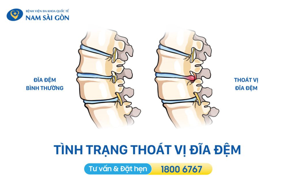 bệnh thoát vị đĩa đệm
