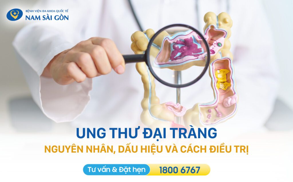 ung thư đại tràng là gì