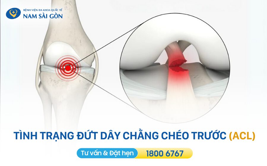 Tình trạng đứt dây chằng chéo trước