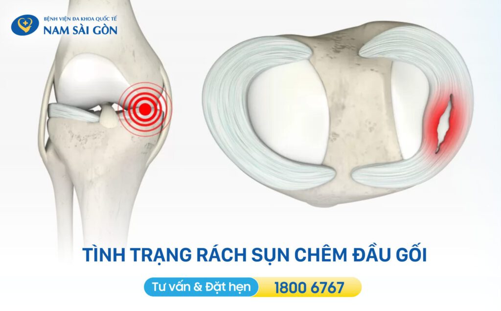 rach-sun-chem-dau-goi-la-gi