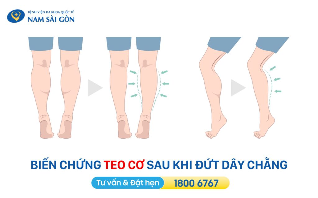 Biến chứng khi bị đứt dây chằng
