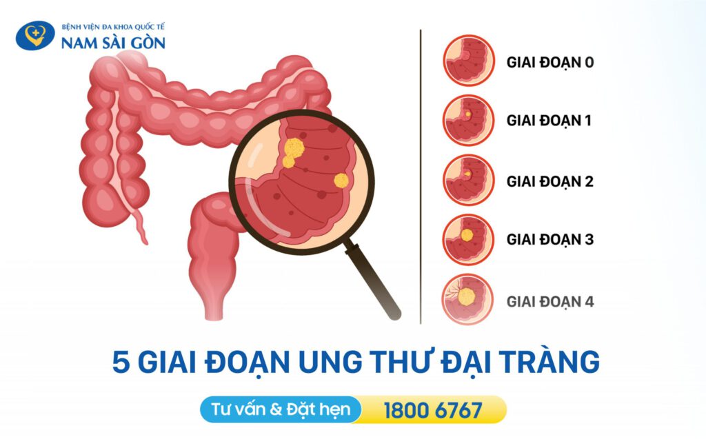 bệnh ung thư đại tràng Các giai đoạn ung thư đại tràng