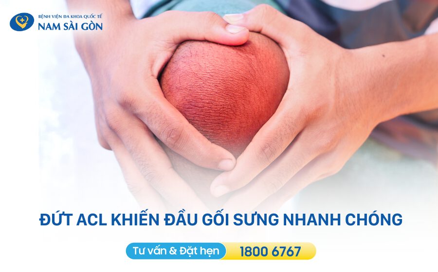Viêm sưng khớp gối sau khi đứt dây chằng chéo trước