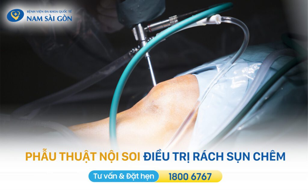 phau-thuat-noi-soi-khau-sun-chem