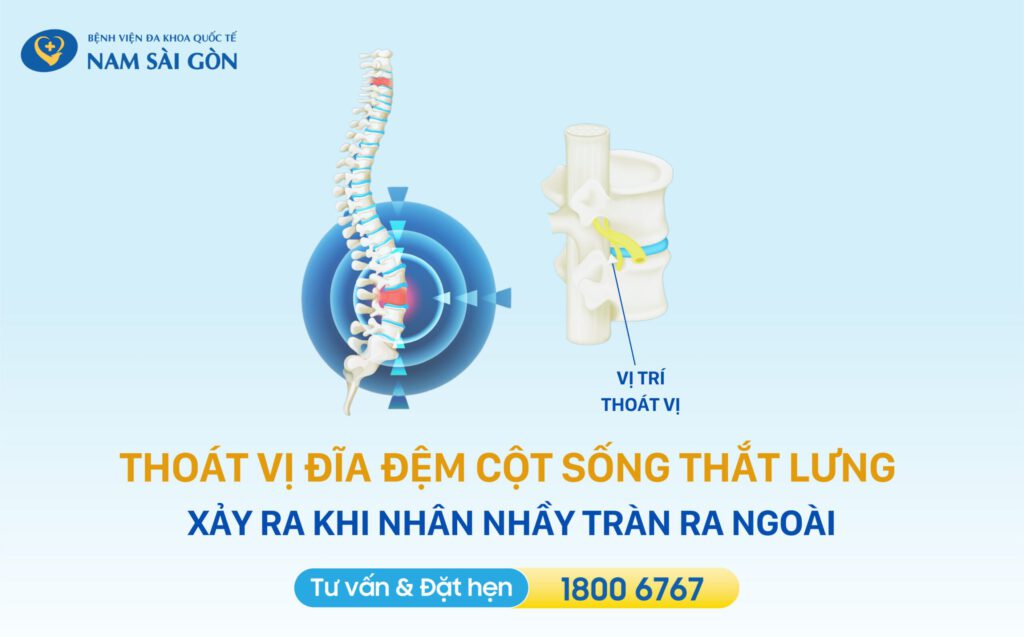 Thoát vị đĩa đệm cột sống thắt lưng là gì