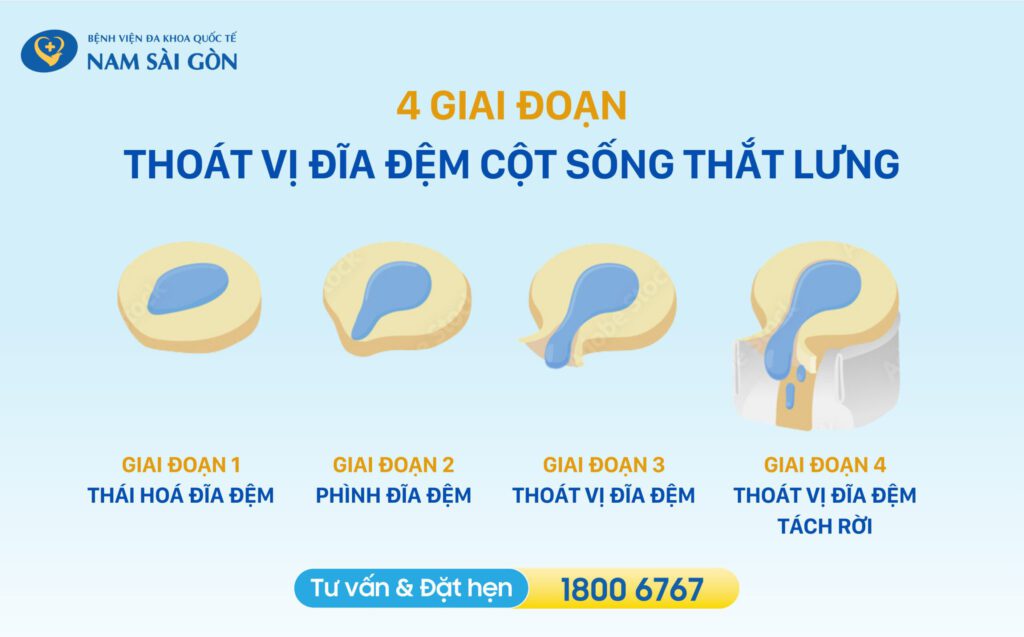 Các giai đoạn của bệnh thoát vị đĩa đệm cột sống thắt lưng