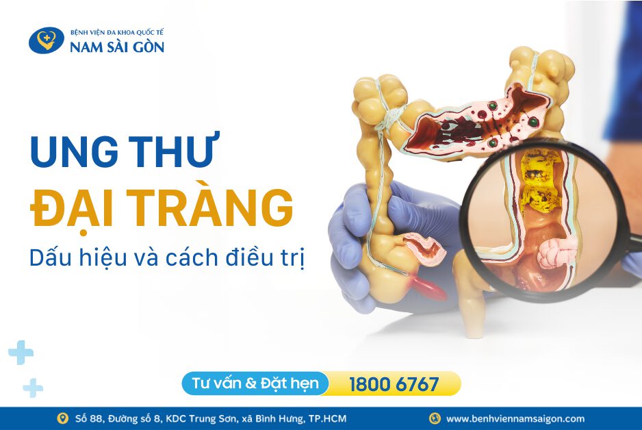 UNG THƯ ĐẠI TRÀNG – NGUYÊN NHÂN, TRIỆU CHỨNG VÀ CÁCH ĐIỀU TRỊ