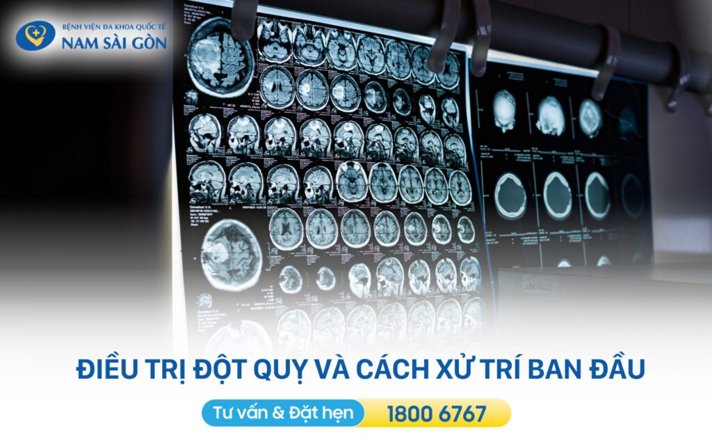 điều trị đột quỵ