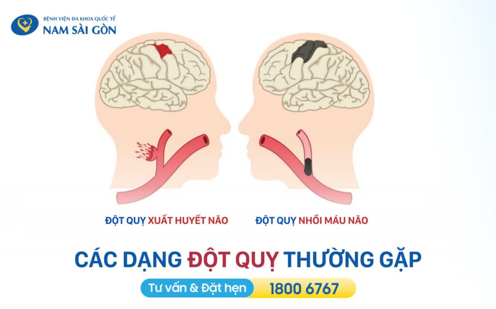 các dạng tai biến mạch máu não