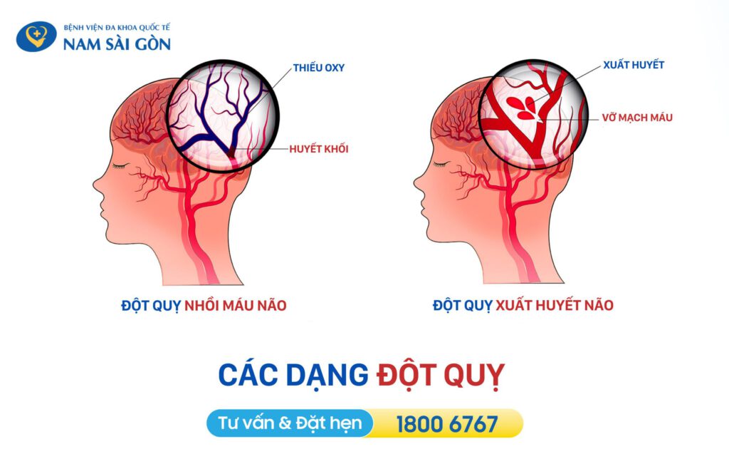 nhận biết dấu hiệu tai biến mạch máu não qua các dạng đột quỵ