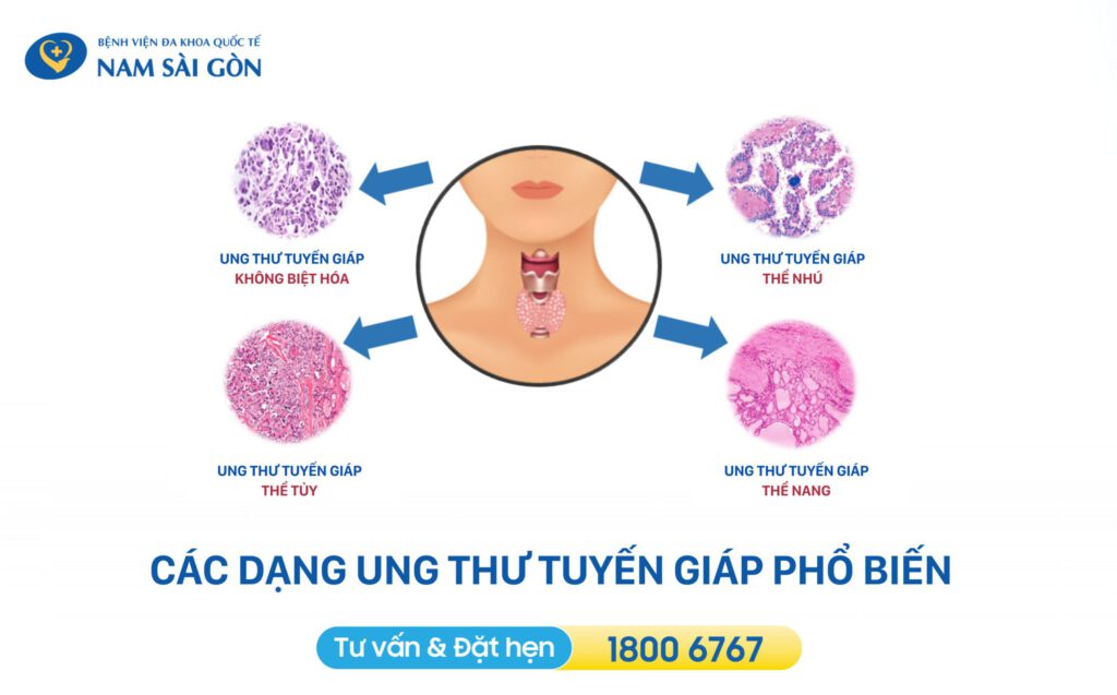 các loại ung thư tuyến giáp hay các loại k tuyến giáp