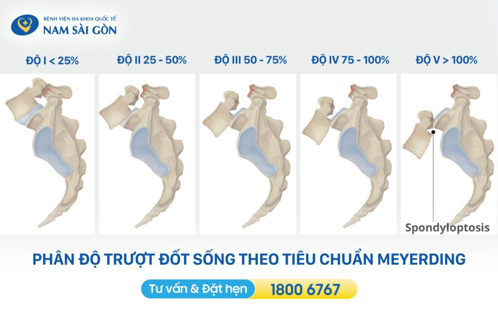 phân độ trượt đốt sống